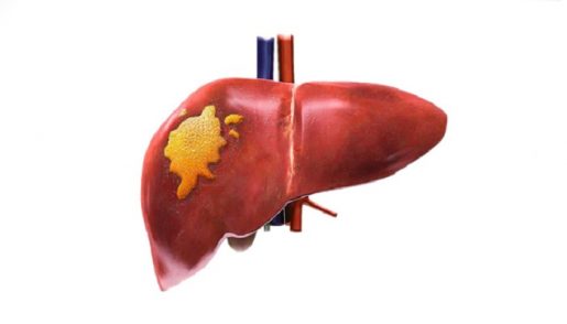 hepatocellular-carcinoma