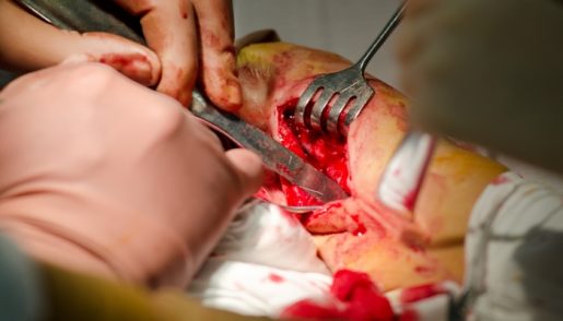surgicalpain