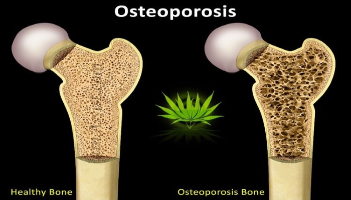 Использование марихуаны в борьбе с остеопорозом