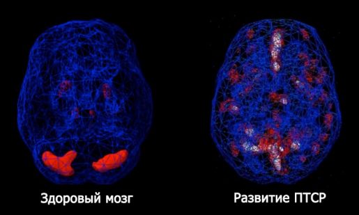 посттравмотическое стрессовое расстройство