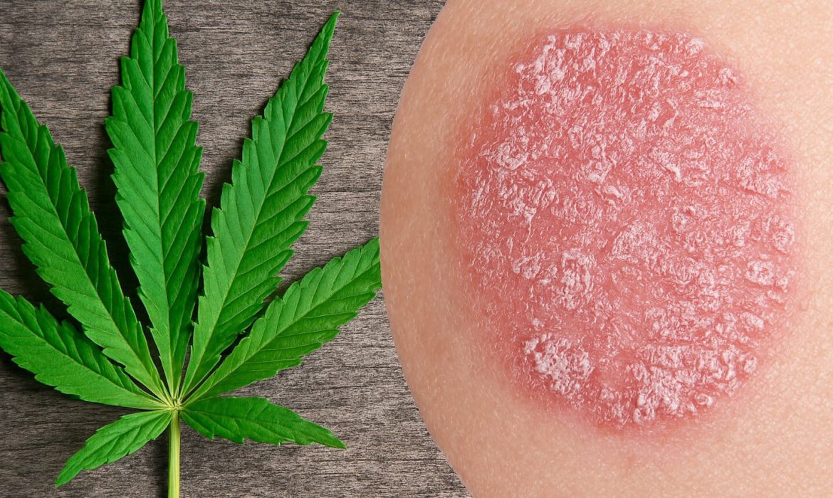 Каннабис и псориаз