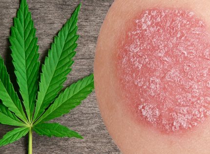 Каннабис и псориаз