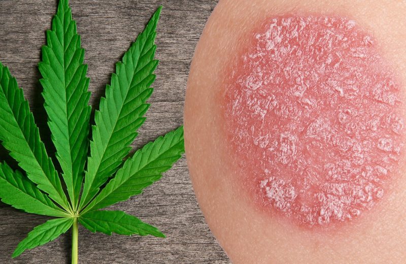 ганжа и псориаз