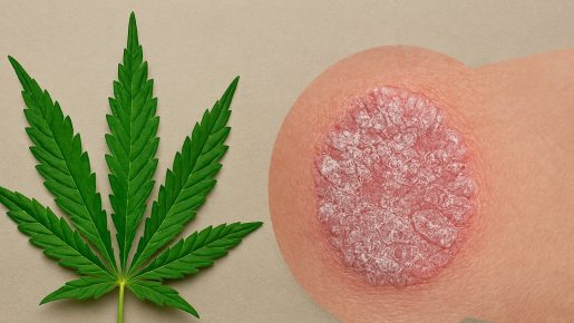 псориаз и ганжа